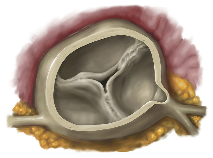 Narrowing and insufficiency of an aortic valve, illustration Illustration showing stenosis  narrowing  and insufficiency of an aortic valve caused by rheumatic fever. Here all commissures are merged together. This prevents the outflow of blood from the ventricle into the aorta. The aortic valve also cannot stop the backflow of blood from the aorta into the ventricle., Photo by MEDICAL GRAPHICS MICHAEL HOFFMANN SCIENCE PHOTO LIBRARY