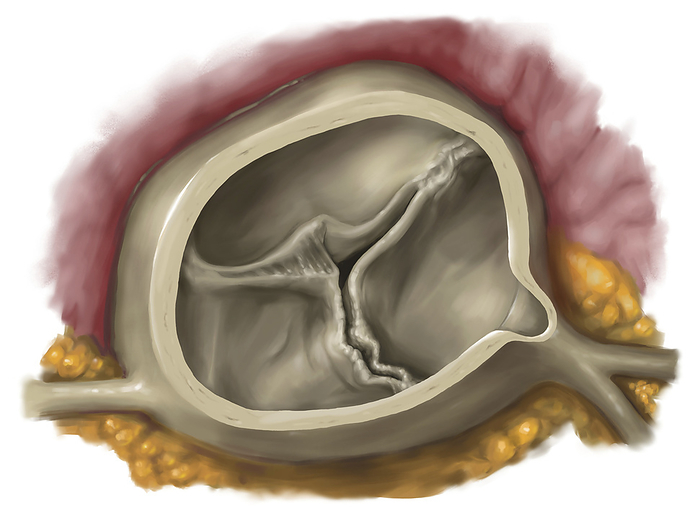 Moderate narrowing of the aortic valve, illustration Illustration of a moderate stenosis  narrowing  of the aortic valve caused by rheumatic fever. The merging of a commissure  left, centre  can be seen as well as the beginning of the merger of the other flaps. This prevents the outflow of blood from the ventricle into the aorta. Rheumatic fever is a disease that can develop after a bacterial infection, causing painful joints and heart problems. It can affect the heart, joints, brain and skin. Some symptoms of rheumatic fever include a high temperature, breathlessness and a fast heart rate., Photo by MEDICAL GRAPHICS MICHAEL HOFFMANN SCIENCE PHOTO LIBRARY