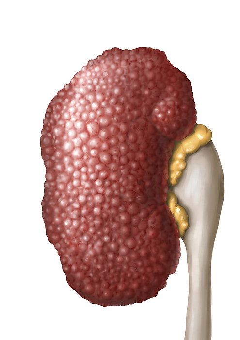 Kidney in chronic hypertension, illustration Illustration of changes to the kidney in a case of chronic  long term  hypertension  high blood pressure . The kidney has shrunk and its surface is exhibiting widespread granulation. The kidneys filter waste products from the blood. Sustained high blood pressure damages the kidney s filtering units  nephrons , which become replaced with fibrous scar tissue, making them unable to function. Toxic substances build up in the blood, leading to kidney failure, which can be fatal., Photo by MEDICAL GRAPHICS MICHAEL HOFFMANN SCIENCE PHOTO LIBRARY