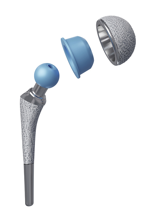 Total hip joint prosthesis, illustration Total hip joint prosthesis. Illustration of the design of a total hip joint endoprosthesis. This shows the structure of the prosthesis which has a acetabular implant  socket, top , femoral head  ball, blue , inlay, and hip stem  grey, bottom . The socket gets fitted into the pelvis, and the hip stem and femoral head is fitted where the top of the femur bone would be. A hip prosthesis mimics the old ball and socket joint, which is often replaced due to osteoarthritis or severe injury, to restore the full mobility and functionality of the hip joint., Photo by MEDICAL GRAPHICS MICHAEL HOFFMANN SCIENCE PHOTO LIBRARY