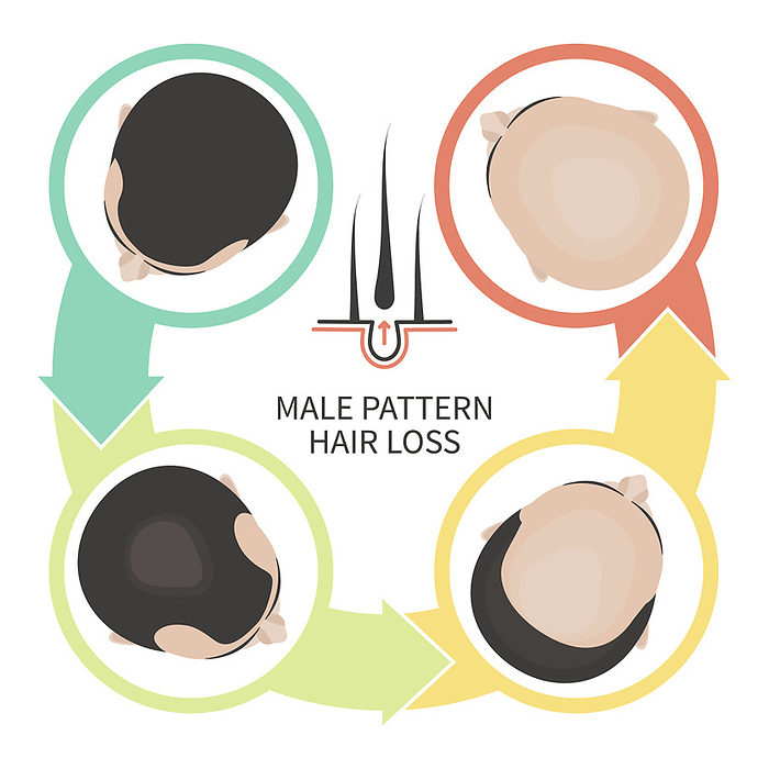 Male pattern hair loss, illustration Male pattern hair loss, illustration., Photo by ART4STOCK SCIENCE PHOTO LIBRARY