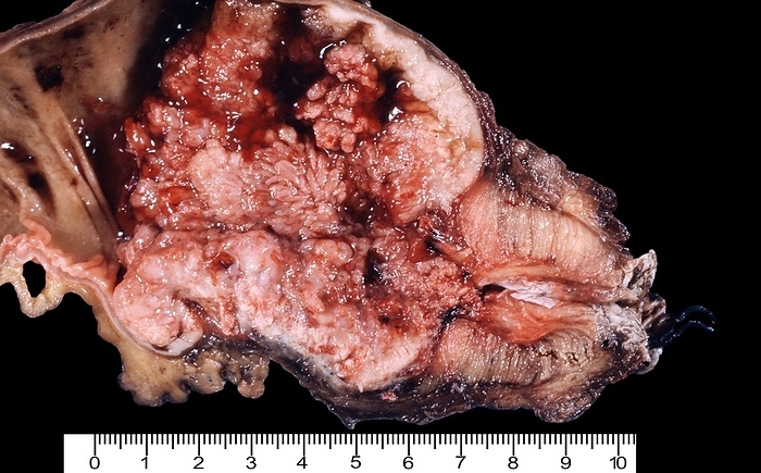 Colorectal cancer Colectomy resection sample in a case of a very large colorectal cancer  7 8 cm . This is the third most common type of cancer. The most frequent form of colon cancer is adenocarcinoma, constituting 95  of cases. The cancer is located in the rectum, just above the anus. The anal sphincter can be seen at left. Part of the unaffected colon can be seen at right., Photo by JOSE CALVO   SCIENCE PHOTO LIBRARY