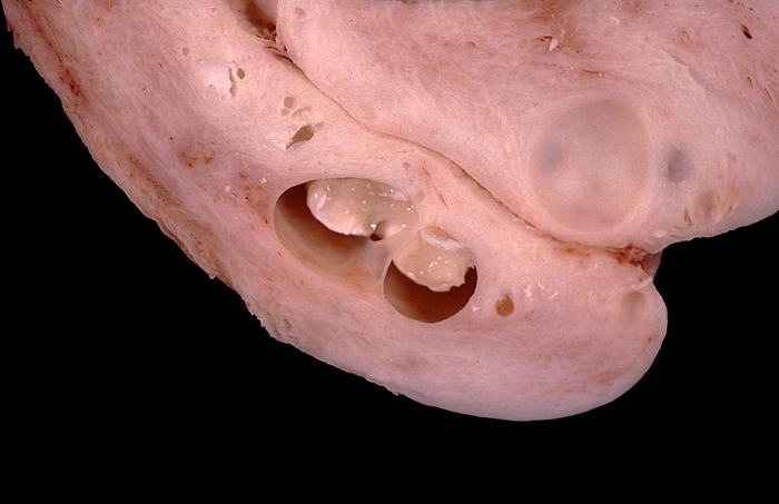 Nabothian cysts on cervix Human uterine cervix, sectioned along the cervical canal. The lower end of the cervix that bulges through the anterior wall of the vagina, known as the ectocervix, or vaginal portion of the cervix, is located in the bottom of the sample. Along the cervical canal, several large nabothian cysts, or nabothian follicles, can be seen., Photo by JOSE CALVO   SCIENCE PHOTO LIBRARY