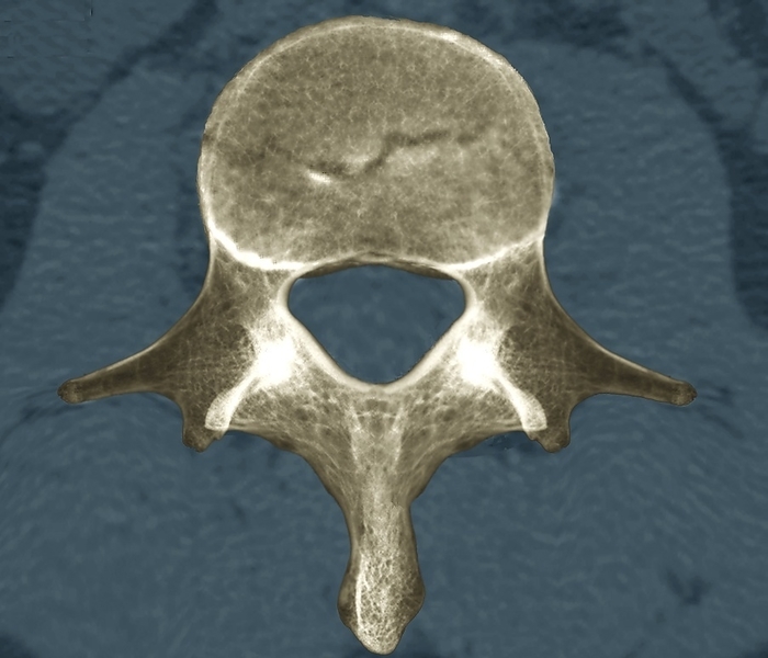 Vertebral body fracture, CT scan Coloured composite 2D and 3D frontal computed tomography  CT  scans of the L1 lumbar vertebra of a 31 year old patient who had a free fall accident. A horizontal fracture is seen in the upper part of the vertebral body. , Photo by ZEPHYR SCIENCE PHOTO LIBRARY