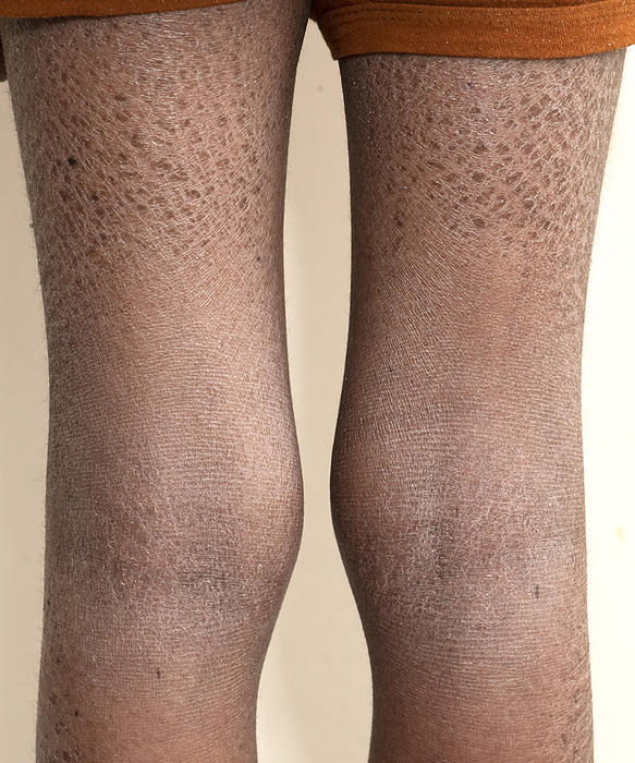 X linked ichthyosis X linked ichthyosis on the legs of a male teenager. This is a rare genetic skin disorder that is caused by a deficiency of the enzyme steroid sulphatase. In the absence of the enzyme the skin cells become sticky, preventing the normal shedding of skin, leading rough, dark, scaly skin. It only affects males. There is no cure and treatment is with creams and emollients to exfoliate and hydrate the skin., Photo by SCIENCE PHOTO LIBRARY