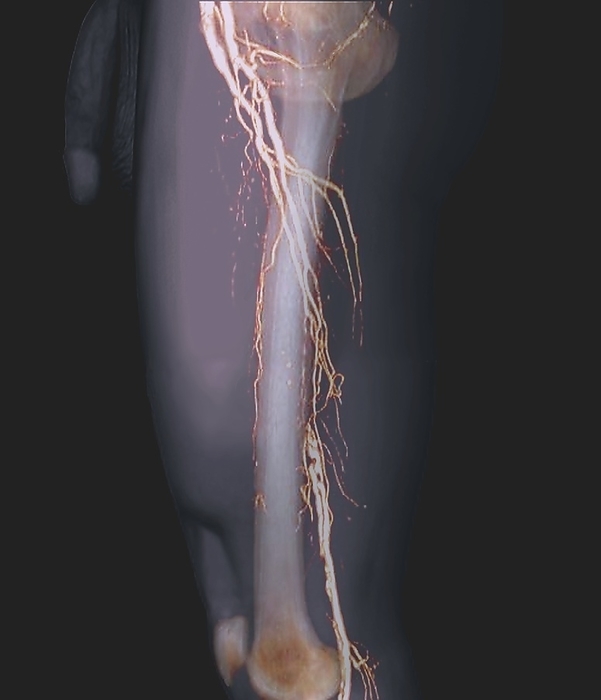 Nearly blocked femoral arteries, 3D CT angiogram Nearly blocked femoral arteries. Coloured lateral 3D computed tomography  CT  angiogram  blood vessel X ray  of the left leg of a 62 year old man with preocclusive stenosis of the femoral arteries in his thigh. The arteries  pink  have been highlighted using a contrast medium. Preocclusive stenosis is where a blood vessels has a narrowed area  stenosis  and is close to being completely blocked  occluded . In this case, collateral blood vessels in the rest of the leg have helped maintain the blood flow around the affected area  near centre . This lateral  side  view includes the patient s soft tissues and thigh bone  femur .
