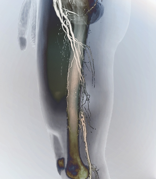 Nearly blocked femoral arteries, 3D CT angiogram Nearly blocked femoral arteries. Coloured lateral 3D computed tomography  CT  angiogram  blood vessel X ray  of the left leg of a 62 year old man with preocclusive stenosis of the femoral arteries in his thigh. The arteries  white  have been highlighted using a contrast medium. Preocclusive stenosis is where a blood vessels has a narrowed area  stenosis  and is close to being completely blocked  occluded . In this case, collateral blood vessels in the rest of the leg have helped maintain the blood flow around the affected area  near centre . This lateral  side  view includes the patient s soft tissues and thigh bone  femur .