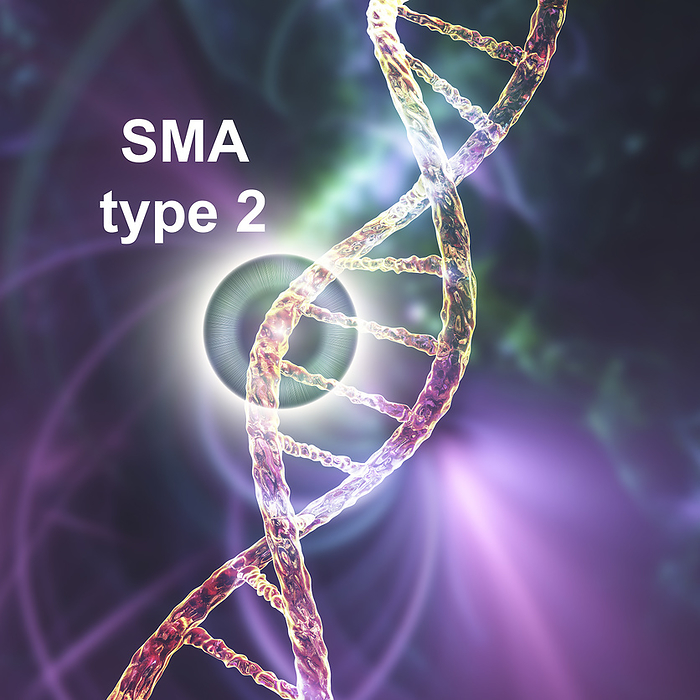 Spinal muscular atrophy, illustration Illustration of spinal muscular atrophy, SMA, type 2, a genetic neuromuscular disorder with progressive muscle wasting because of loss of motor neurons due to mutation in the SMN1 gene., Photo by KATERYNA KON SCIENCE PHOTO LIBRARY