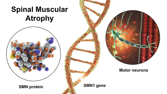 Spinal muscular atrophy, illustration Illustration of spinal muscular atrophy, SMA, a genetic neuromuscular disorder with progressive muscle wasting due to mutation in the SMN1 gene, deficiency in SMN protein, and loss of motor neurons., Photo by KATERYNA KON SCIENCE PHOTO LIBRARY