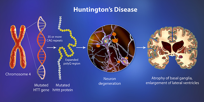 Molecular genesis of Huntington s disease, 3D illustration Molecular genesis of Huntington s disease, illustration. Expansion of the CAG trinucleotide sequence in the htt gene causes production of mutated Huntingtin protein leading to neurodegeneration., Photo by KATERYNA KON SCIENCE PHOTO LIBRARY