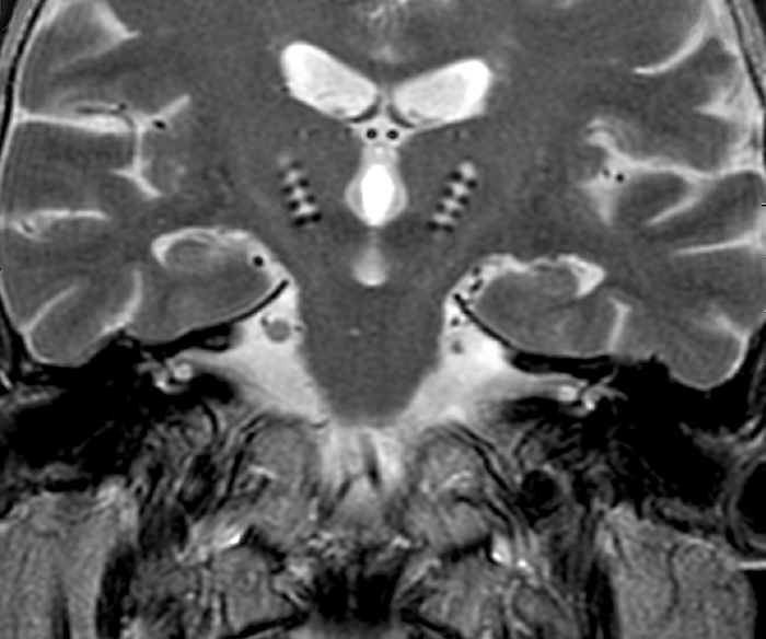 Parkinson s disease electrode implants, MRI scan Parkinson s disease electrode implants. Coronal magnetic resonance imaging  MRI  scan of the brain of a 63 year old man with Parkinson s disease where electrodes have been implanted  upper centre . Progressive degeneration of the brain s neurons leads to the symptoms of Parkinson s. These symptoms include, tremor, muscular rigidity, poor balance and depression. Here, the patient is being treated using the drug Levodopa, which is no longer effective after six years of use. This neurosurgical treatment involves the implantation of electrodes in deep areas of the brain. This sends electrical impulses to specific areas of the brain, helping to negate and control the effects of the disease., Creditline:ZEPHYR SCIENCE PHOTO LIBRARY