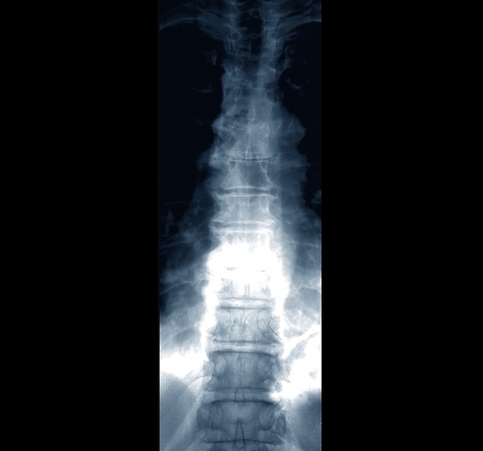 Back pain, X ray X ray of the dorsal spine of a 68 year old female patient with back pain. The scan shows bone demineralisation and the formation of bony growths  osteophytes  with disc pinching., Creditline:ZEPHYR SCIENCE PHOTO LIBRARY