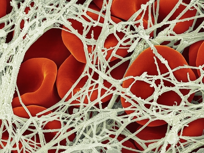 Blood clot, SEM Coloured scanning electron micrograph  SEM  of a menstrual blood clot showing little granularity. Human red blood cells trapped in a fibrin blood clot. Platelets are cell fragments in the blood that play an essential role in blood clotting and wound repair. Platelets can also activate certain immune responses. Platelets are formed in the red bone marrow, lungs, and spleen by fragmentation of very large cells known as megakaryocytes. Platelets in the blood are small oval disks and are termed nonactivated platelets or thrombocytes. Platelets serve as the body s first line of defense to prevent excessive blood loss. When an injury such as a cut is sustained, platelets change their shape  now known as activated platelets , become sticky and build up on a vessel wall to form a plug. They are also involved in the secretion of a chemical platelet factor which helps produce threads of fibrin. Bloods cells collect in the entangled fibrin and platelet mass forming a blood clot at the site. Magnification: x1,600 when shortest axis printed at 25 millimetres., Creditline:DENNIS KUNKEL MICROSCOPY SCIENCE PHOTO LIBRARY