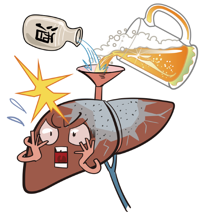 Cirrhosis of the liver - a disease in which the liver hardens due to excessive consumption of alcohol.