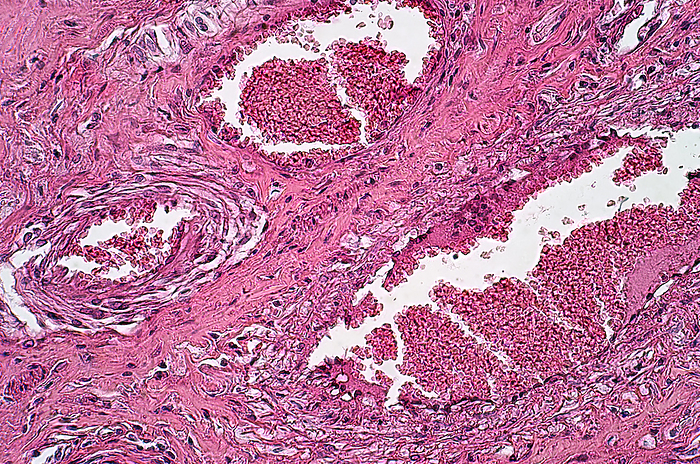 Necrotic oesophagitis, light micrograph Light micrograph of necrotic oesophagitis. Haematoxylin and eosin stain., Photo by CHOKSAWATDIKORN   SCIENCE PHOTO LIBRARY