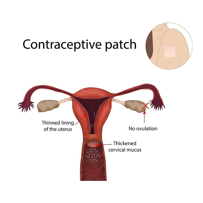 Contraceptive patch, illustration Contraceptive patch, illustration., Photo by VERONIKA ZAKHAROVA SCIENCE PHOTO LIBRARY