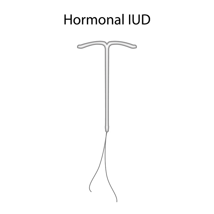 Hormonal intrauterine devices, illustration Hormonal intrauterine devices, illustration., Photo by VERONIKA ZAKHAROVA SCIENCE PHOTO LIBRARY