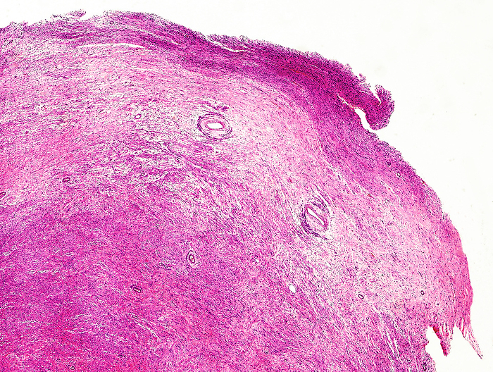 Adult neuroblastoma, light micrograph Light micrograph of a section of human tissue showing adult neuroblastoma. This refers to a cancer that develops from the immature nerve cells found in several parts of the body. It most commonly arises in and around the adrenal glands, which have similar origins to nerve cells and sit atop of the kidneys. However, neuroblastoma can also develop in other areas of the abdomen and in the chest, neck and near the spine, where groups of cells exist. Neuroblastoma is the third most common malignancy of the paediatric population, although extremely rare in the adult population., Photo by NIGEL DOWNER SCIENCE PHOTO LIBRARY