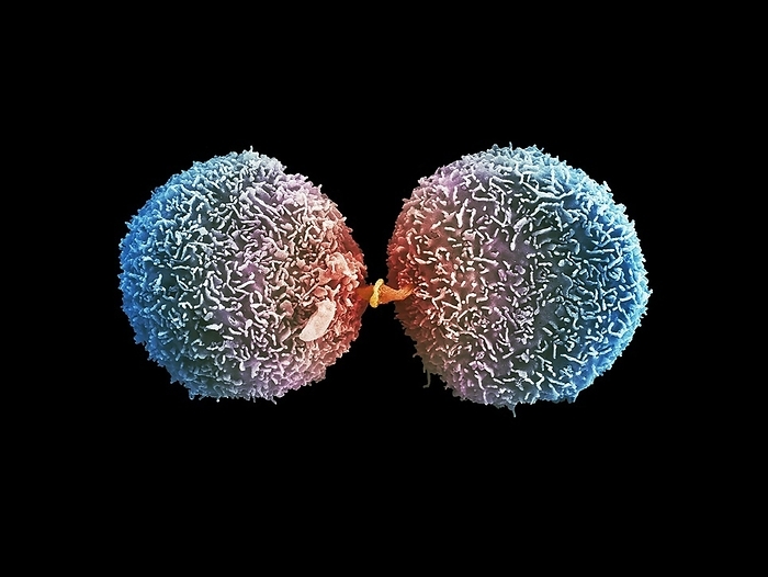 Lung cancer cells dividing, SEM Lung cancer cells dividing, coloured scanning electron micrograph  SEM . Lung cancer occurs when abnormal cells divide in a chaotic and uncontrolled manner resulting in the formation of a tumour in the lungs. Lung cancer is the most common cause of cancer death in the UK. In this image the cells are undergoing cytokinesis which is the physical process of cell division which divides the parental cell into two daughter cells. At the end of cytokinesis, the two daughter cells remain connected by the midbody for a short time. The midbody is organised by a set of microtubules and its main function is to localize the site of natural detachment  abscission  between the two daughter cells. The strcuture that accomplishes cytokinesis is the contractile ring which is a dynamic assembly composed of actin and myosin filaments and structural and regulatory proteins. The ring assembles just beneath the plasma membrane and contracts to constrict the cell into two. Magnification: x4000 when printed at 10cm wide., Photo by ANNE WESTON, FRANCIS CRICK INSTITUTE SCIENCE PHOTO LIBRARY