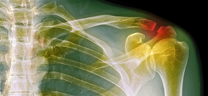 Fractured collar bone, X ray Coloured X ray of the left shoulder of a 44 year old man with a fractured clavicle  collar bone  after falling off bike., Photo by DR P. MARAZZI SCIENCE PHOTO LIBRARY