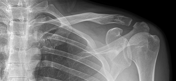 Fractured collar bone, X ray X ray of the left shoulder of a 44 year old man with a fractured clavicle  collar bone  after falling off bike., Photo by DR P. MARAZZI SCIENCE PHOTO LIBRARY