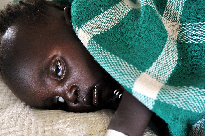 South Sudan, baby with diarrhea Amori, lying in bed with a painful expression due to severe diarrhea, at the DOT clinic in Kapoeta, Eastern Equatoria State, South Sudan, 20 February 21, 2012  photo by Hiroyuki Miura