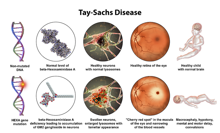 Tay Sachs disease, illustration Illustration of Tay Sachs disease, a genetic disorder that progressively destroys brain neurons. It is caused by a mutation in the HEXA gene of chromosome 15 leading to deficiency of hexosaminidase A. Neurons become swollen with lamellar inclusions due to accumulation of gangliosides in lysosomes with subsequent neuronal degeneration. Tay sachs is most commonly seen in infants, manifesting in muscle weakness and decreased motor function, vision and hearing loss, and intellectual disability. All patients with Tay Sachs disease have a   cherry red   spot in the eye retina, easily observable by a physician using an ophthalmoscope, in the back of their eyes., by KATERYNA KON SCIENCE PHOTO LIBRARY
