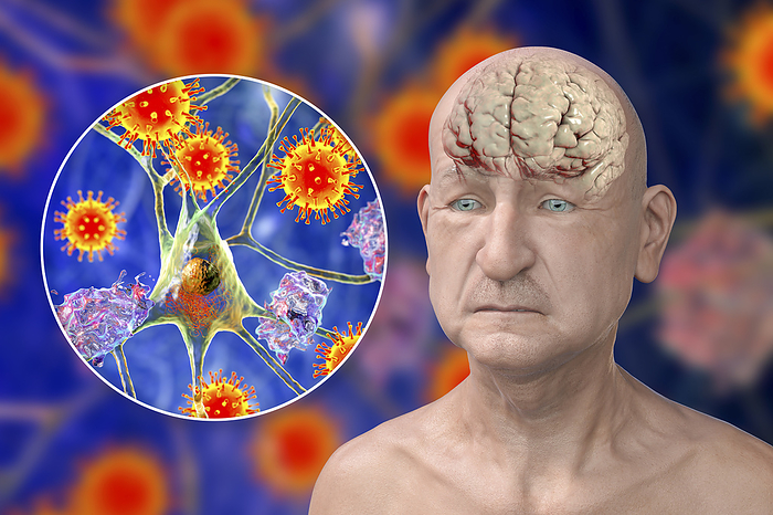 Infectious aetiology of dementia, illustration Infectious aetiology of dementia. Conceptual computer illustration showing an elderly person with Alzheimer s disease, progressive impairments of brain functions, amyloid plaques in the brain, and viruses attacking neurons., by KATERYNA KON SCIENCE PHOTO LIBRARY