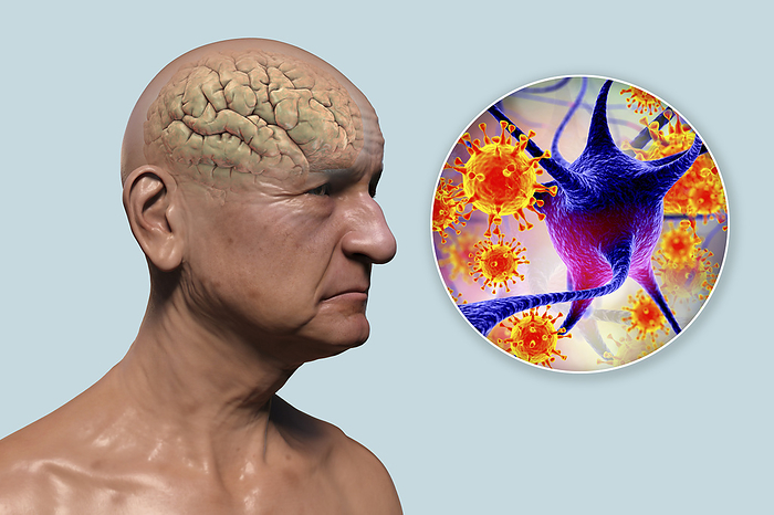 Infectious aetiology of dementia, illustration Infectious aetiology of dementia. Conceptual computer illustration showing an elderly person with progressive impairments of brain functions, amyloid plaques in the brain, and viruses attacking neurons., by KATERYNA KON SCIENCE PHOTO LIBRARY