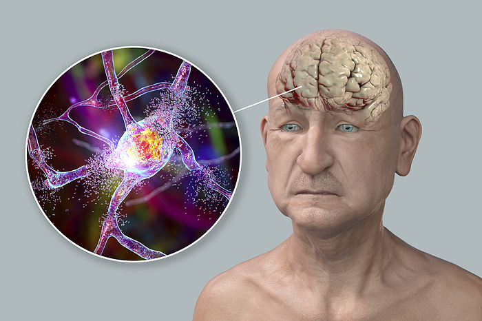 Elderly person with dementia, illustration Dementia and Alzheimer s disease. Conceptual computer illustration showing neurodegeneration and progressive impairment of brain functions in the elderly., by KATERYNA KON SCIENCE PHOTO LIBRARY