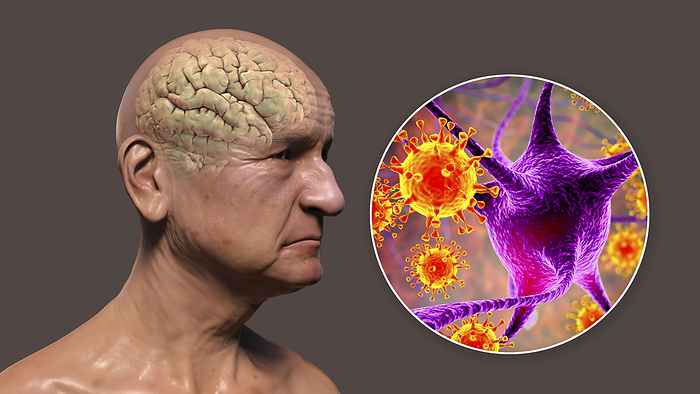 Infectious aetiology of dementia, illustration Infectious aetiology of dementia. Conceptual computer illustration showing an elderly person with progressive impairments of brain functions and viruses attacking neurons., by KATERYNA KON SCIENCE PHOTO LIBRARY
