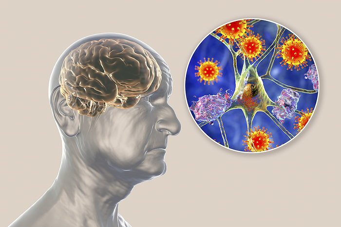 Infectious aetiology of dementia, illustration Infectious aetiology of dementia. Conceptual computer illustration of an elderly person with Alzheimer s disease, progressive impairments of brain functions, amyloid plaques in the brain, and viruses attacking neurons., by KATERYNA KON SCIENCE PHOTO LIBRARY