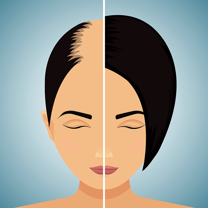 Hair loss in women, conceptual illustration Hair loss in women, conceptual illustration, by ART4STOCK SCIENCE PHOTO LIBRARY