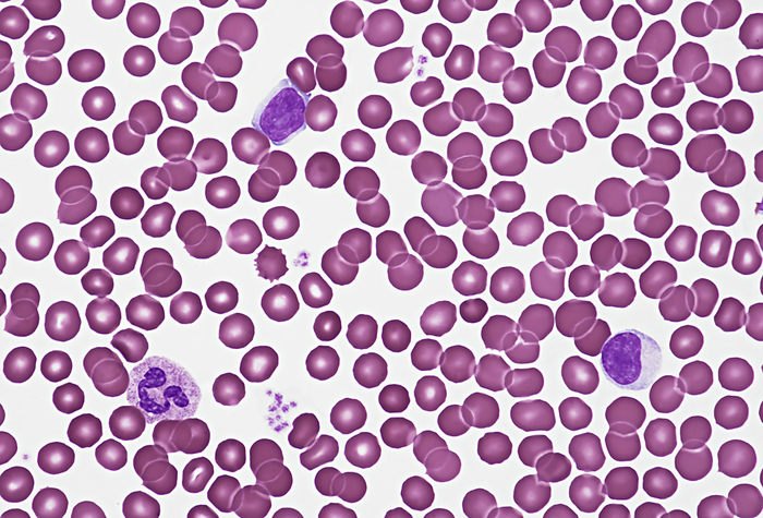 Blood smear, light micrograph Blood smear. Light micrograph showing human blood cells. Erythrocytes  red blood cells  are pink. They make up the majority of blood cells and carry oxygen to body tissues and carbon dioxide to the lungs. Three types of white blood cell  purple  can also be seen. They are, an eosinophil  bottom left ,  a lymphocyte  lower right  and a monocyte  upper centre . White blood cells are part of the body s immune system. Eosinophils are involved in the body s allergic response and also help to defend the body from invading parasites. Lymphocytes are involved in the production of antibodies and attacking virus infected and tumour cells. Monocytes are the largest white blood cell. They engulf and digest invading bacteria and cell debris. Also seen are platelets  small purple particles , which are cell fragments that play an essential role blood clotting. Magnification: x1000 when printed at 15cm wide., Photo by EYE OF SCIENCE SCIENCE PHOTO LIBRARY