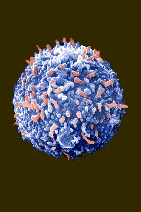 Antibody production by a hybridoma cell Scanning electron micrograph of a hybridoma cell, 10microns in diameter. Hybridoma cells are laboratory made, by combining two different cell types  B cells of the immune system of a mouse that are producing an antibody, and cells from an immortal cell line called a myeloma. The cells are fused together using electric fields or polyethylene glycol. The resulting immortal  hybridoma  cell produces the antibody in amounts that can be harvested. The nature of the antibody depends on the antigen to which the mouse was exposed. Such  monoclonal antibodies  can therefore be designed to be tools to detect molecules of specific interest, even when those molecules are present in minute amounts. MABs are now used in the early diagnosis of cancers, and in targeted treatments of cancer and virus disease  Covid . Their development in 1975 led to a Nobel prize for Cesar Milstein and George Kohler., Photo by DR JEREMY BURGESS SCIENCE PHOTO LIBRARY