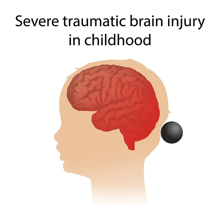 Severe traumatic brain injury in childhood, illustration Severe traumatic brain injury in childhood, illustration. Injury to the brain is caused by an external force., Photo by VERONIKA ZAKHAROVA SCIENCE PHOTO LIBRARY