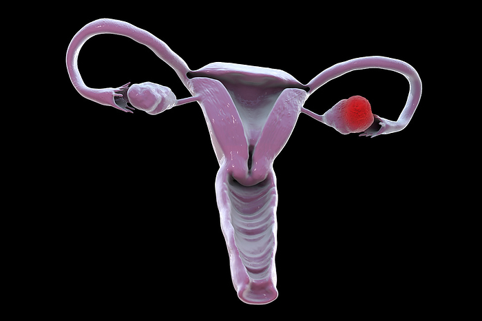 Ovarian cancer, illustration Ovarian cancer. Computer illustration showing a malignant tumour in the left ovary. This cancer is most common in women over age 50 and in those who have never had children  less common in women who have taken oral contraceptives. The primary form of cancer may spread to other organs. In most cases there are no symptoms until an advanced stage. The first symptom is a vague abdominal discomfort and swelling. Ovarian cancer is treated by surgical removal of the growth, which may involve removal of the ovary, fallopian tubes and even the uterus. Anti cancer drugs would follow., Photo by KATERYNA KON SCIENCE PHOTO LIBRARY