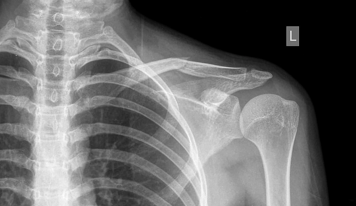 Fractured collar bone, X ray X ray of a left clavicle  collar bone  fracture., Photo by RAJAAISYA SCIENCE PHOTO LIBRARY
