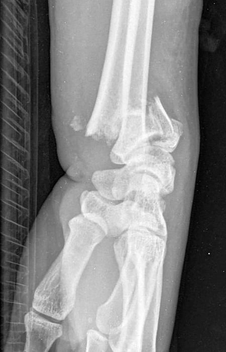 Colles fracture, X ray X ray of a Colles fracture. This is a fracture of the radius  lower arm bone  near the wrist, with a posterior displacement of the bone., Photo by RAJAAISYA SCIENCE PHOTO LIBRARY