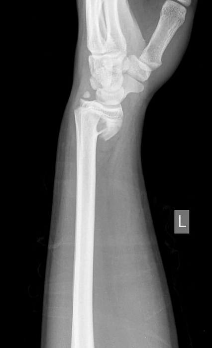 Smith fracture, X ray X ray of a Smith fracture. This is a fracture of the radius  lower arm bone  near the wrist, with an anterior displacement of the bone., Photo by RAJAAISYA SCIENCE PHOTO LIBRARY