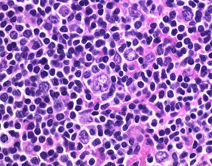 Nodular lymphocyte predominant Hodgkin lymphoma, micrograph The neoplastic cells of nodular lymphocyte predominant Hodgkin lymphoma are called LP cells   which stands for lymphocyte predominant cells. A single LP cell is seen at the centre of this image. Given the shape of their nucleus with complex infoldings, LP cells have also been referred to as popcorn cells. They have one or more basophilic nucleoli and scant cytoplasm., Photo by WEBPATHOLOGY SCIENCE PHOTO LIBRARY