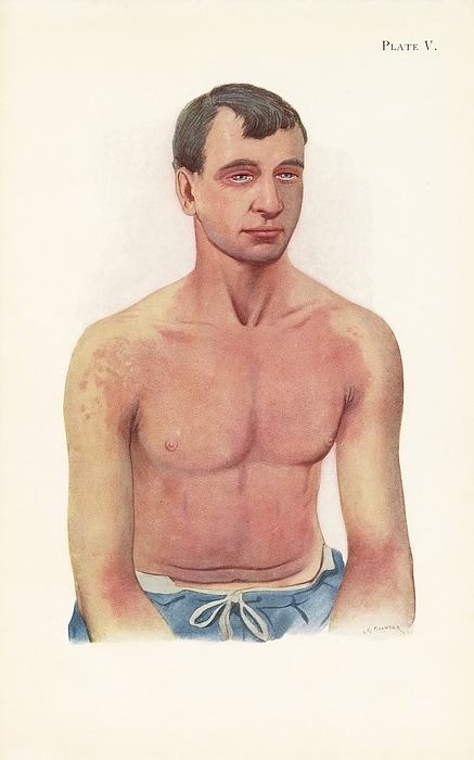 Erythema from mustard gas poisoning, illustration World War One soldier with erythema of the chest, drawn five days after being exposed to mustard gas at Ypres, Belgium on 12th July 1917. Mustard gas was used as a chemical warfare agent in the First World War. Exposure to mustard gas can cause coughing and shortness of breath in the short term. It also has long term effects such as mouth, throat and skin cancer as well as leukaemia. The use of chemical weapons in the First World resulted in 90,000 deaths and more than 1.3 million casualties. Published in An Atlas of Gas Poisoning, 1918., Photo by Science History Institute SCIENCE PHOTO LIBRARY
