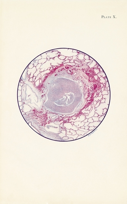 Lung tissue damaged by mustard gas poisoning Illustration showing a microscopic section of human lung tissue damaged by mustard gas poisoning during World War One. The bronchiole is filled with fibrin and pus cells. The lining of the epithelium has also been destroyed. A ring of haemorrhage is seen around the tissue surrounding the bronchiole. The patient from which the lung tissue was taken from, died 40 hours after being exposed to mustard gas. Mustard gas was used as a chemical warfare agent in the World War One. Exposure to mustard gas can cause coughing and shortness of breath in the short term. It also has long term effects such as mouth, throat and skin cancer as well as leukaemia. Illustration published in An Atlas of Gas Poisoning, 1918., Photo by Science History Institute SCIENCE PHOTO LIBRARY