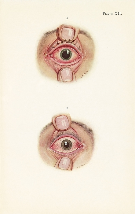 Severe burning of an eye from gas poisoning, illustration Illustration showing the resolution of severe burning of a soldier s eye from gas poisoning. The top image shows the stage of resolution after severe burning and the bottom image shows the late stage of resolution. Exposure to mustard gas, an irritant used as a chemical warfare agent, causes damage to the eyes, skin and respiratory tract. Short term effects of mustard gas include coughing and shortness of breath. Mustard gas also has long term effects such as mouth, throat and skin cancer as well as leukaemia. Illustration published in An Atlas of Gas Poisoning, 1918., Photo by Science History Institute SCIENCE PHOTO LIBRARY