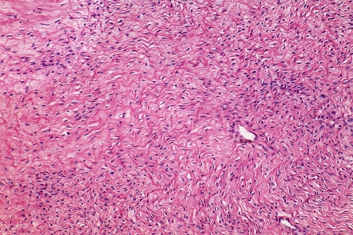Ovarian fibroma, LM Fibroma of the ovary. Light micrograph  LM  of a fibroma of the ovary. Fibromas  or fibroid tumors or fibroids  are benign tumors that are composed of fibrous or connective tissue. They can grow in all organs, arising from mesenchyme tissue. The term  fibroblastic  or  fibromatous  is used to describe tumors of the fibrous connective tissue. Magnification: x100 when printed at 10 centimetres wide. Human tissue., Photo by STEVE GSCHMEISSNER SCIENCE PHOTO LIBRARY