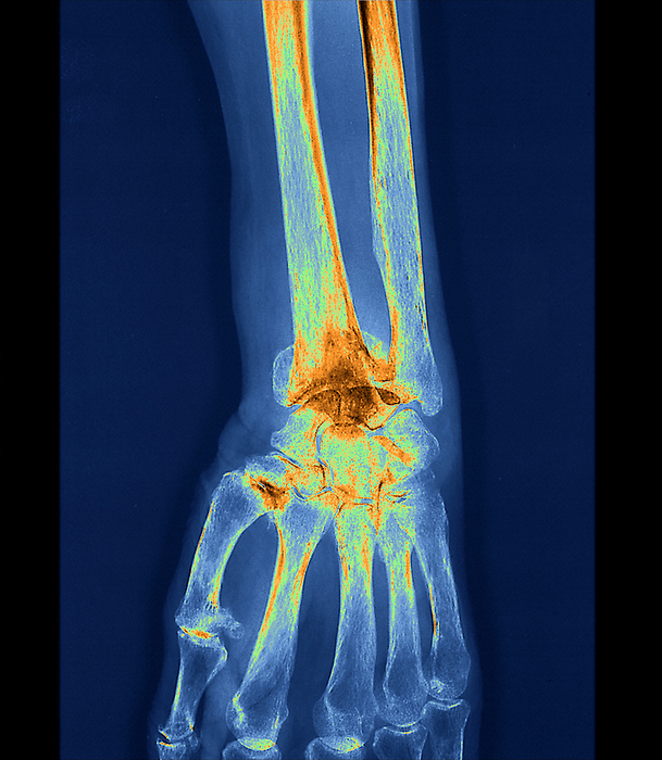 Fractured left wrist, X ray Coloured frontal X ray of the fractured left wrist of a 76 year old female patient who fell from a height. The X ray also shows the presence of a radius fracture with bone displacement on a bone demineralization chart., by ZEPHYR SCIENCE PHOTO LIBRARY