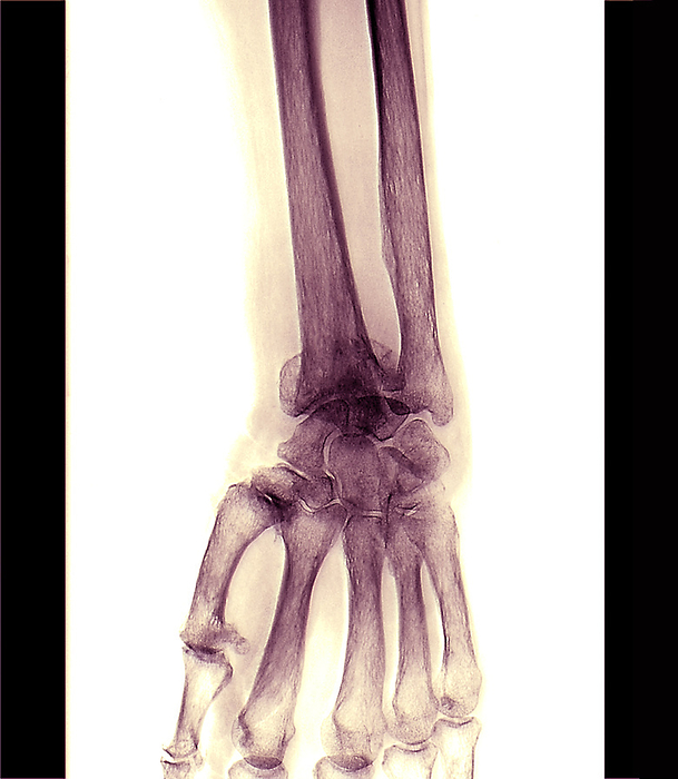 Fractured left wrist, X ray Frontal X ray of the fractured left wrist of a 76 year old female patient who fell from a height. The x ray also shows the presence of a radius fracture with bone displacement on a bone demineralization chart., by ZEPHYR SCIENCE PHOTO LIBRARY