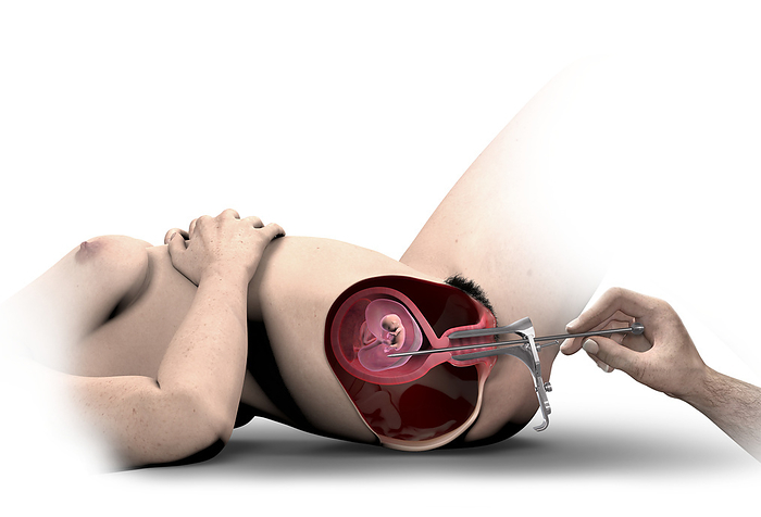 Illegal abortion, illustration Illustration of an abortionist using a knitting needle to induce an  illegal abortion of a pregnant woman. The abortionist is using a speculum  a medical instrument used to hold the vagina open for examination., by CLAUS LUNAU SCIENCE PHOTO LIBRARY