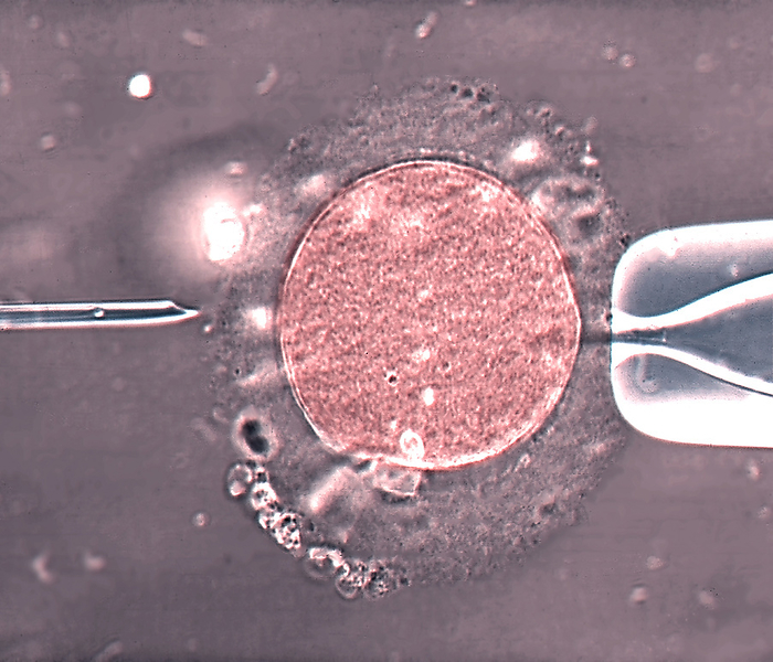 In vitro fertilisation, light micrograph In vitro fertilisation. Coloured light micrograph of a micro needle  left  and pipette  right  that is being used to select a human egg cell  oocyte  during the process of in vitro fertilisation  IVF . The micro needle will be used to inject a human sperm cell into the human egg cell. This IVF technique is known as intracytoplasmic sperm injection  ICSI . The injected sperm fertilises the egg and the resulting zygote is then grown in the laboratory until it reaches an early stage of embryonic development. It is then implanted in the patient s uterus, where it develops into a foetus. IVF allows infertile couples to conceive a child., by ZEPHYR SCIENCE PHOTO LIBRARY