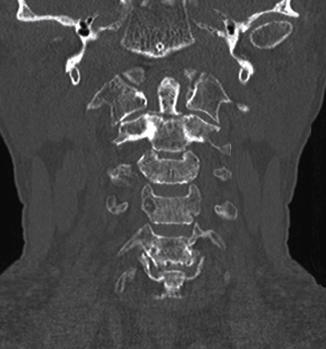 Fractured cervical vertebra, CT scan Frontal computed tomography  CT  scan showing the fractured cervical vertebra of a 67 year old male patient wearing a neck collar. The scan shows the presence of a type II odontoid  C2 vertebra  fracture, with slight bone displacement along with osteoarthritis and bone demineralisation., by ZEPHYR SCIENCE PHOTO LIBRARY